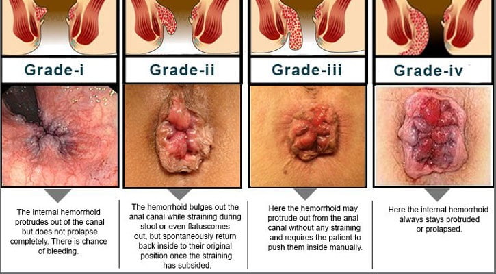 Hemorrhoids Piles Amrut Hospital