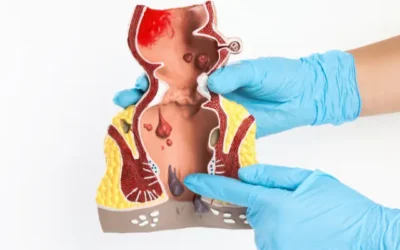 Why Fistulas Recur and How Modern Surgery Can Prevent It?