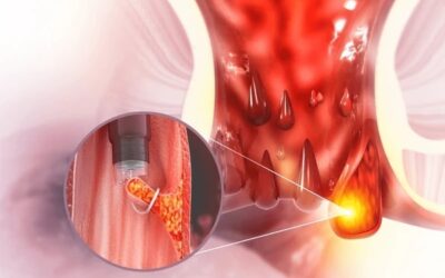 Laser Piles Surgery: Causes, Symptoms and Treatment