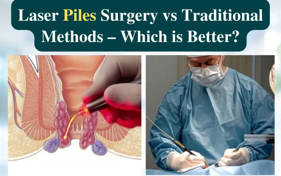 Laser Piles Surgery vs Traditional Methods