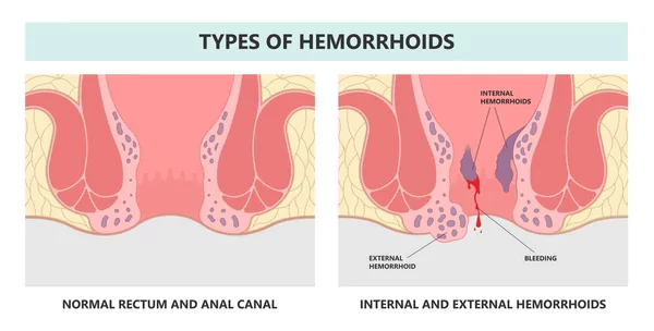 Types of Anal cancer