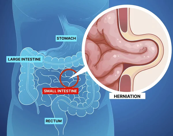 Hernia Symptoms in Men and Women
