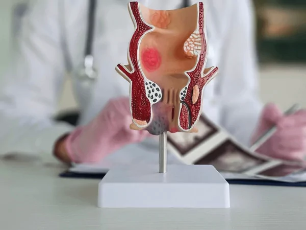 Fistula in Ano: Symptoms & Effective Treatments