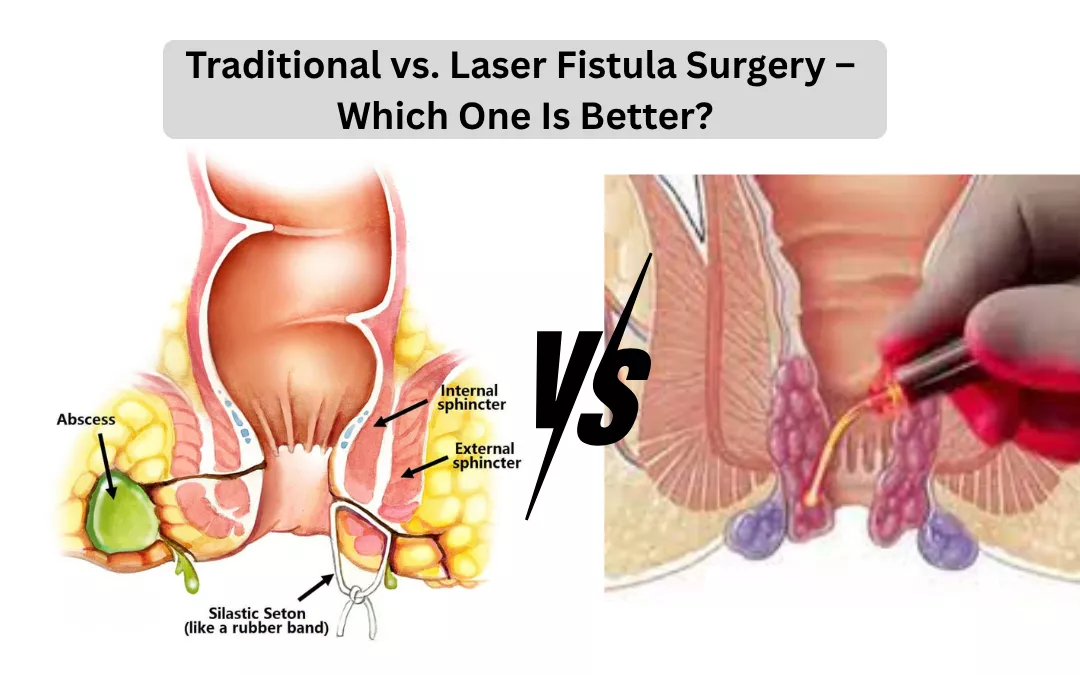Traditional vs Laser Fistula Surgery: Which Treatment Is Better?
