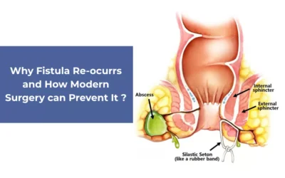 Why Fistulas Recur and How Modern Surgery Can Prevent It?