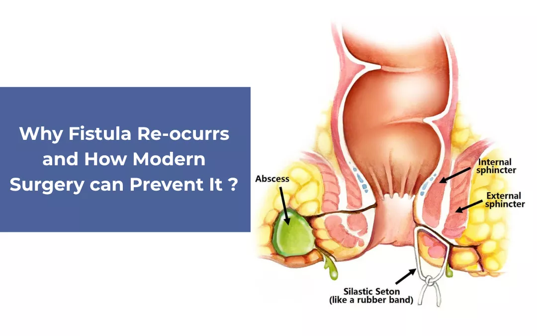 Why Fistulas Recur and How Modern Surgery Can Prevent It?