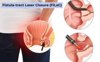 What is the FiLaC Procedure for Fistula?