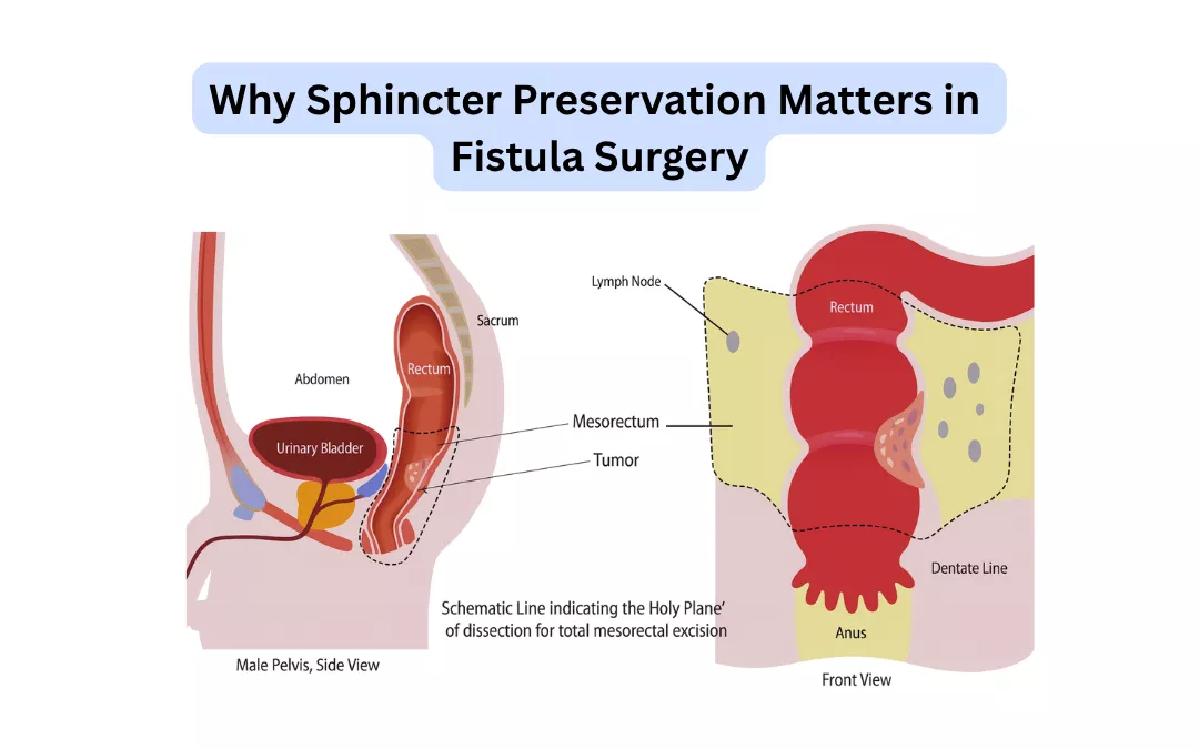 Why Sphincter Preservation Matters in Fistula Surgery?