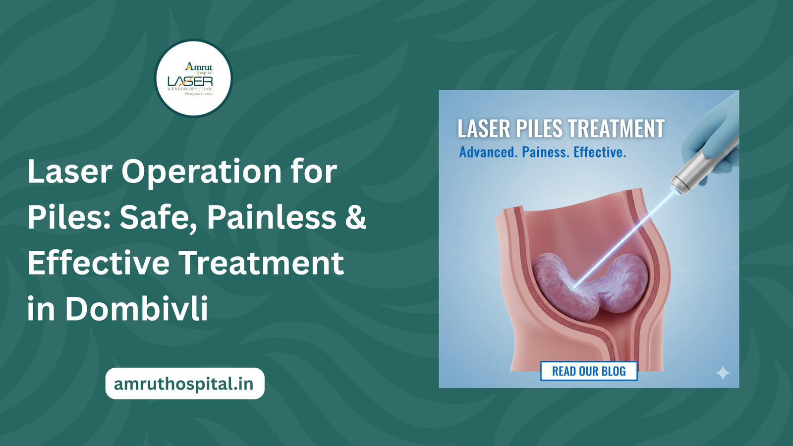 Laser Piles treatment in Dombivali