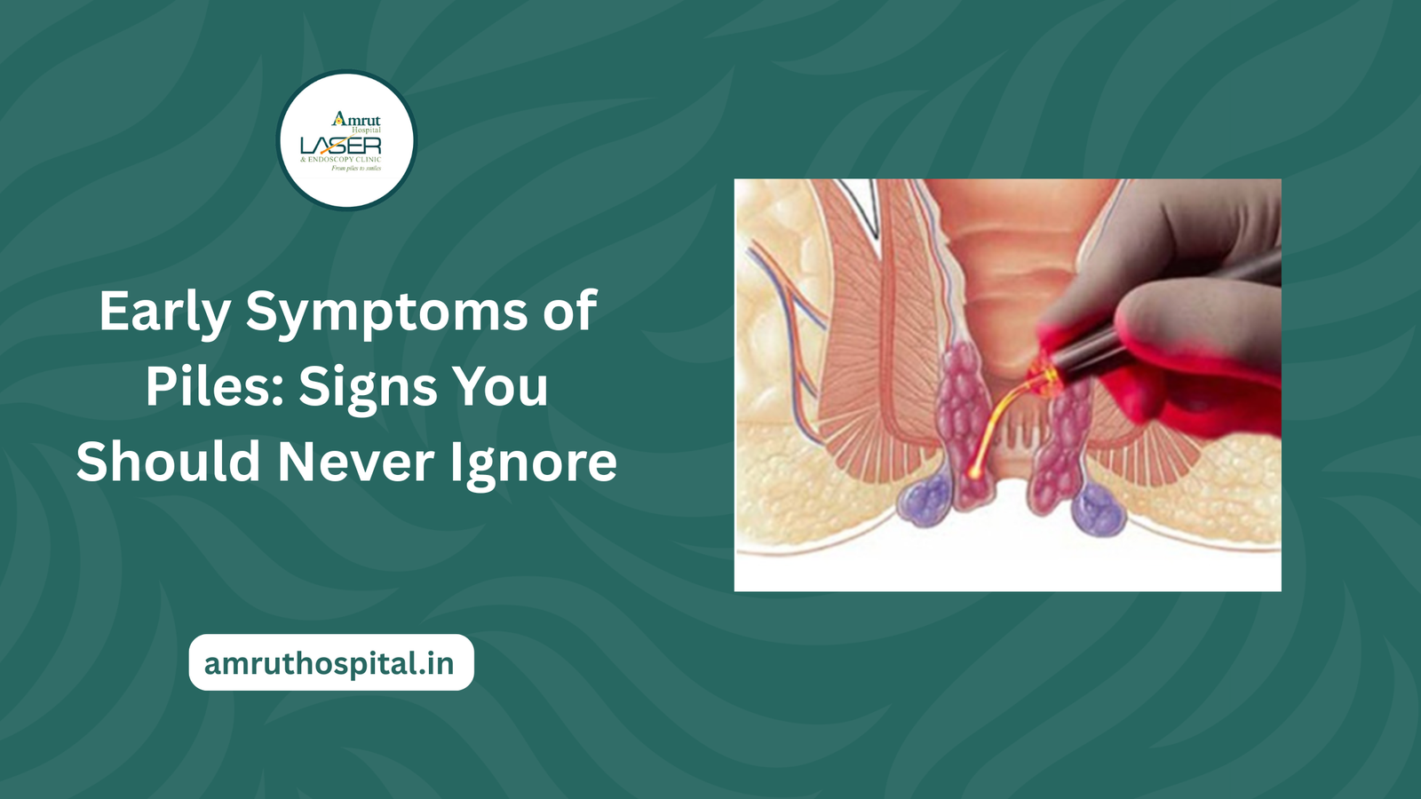 Laser Piles treatment in Dombivali