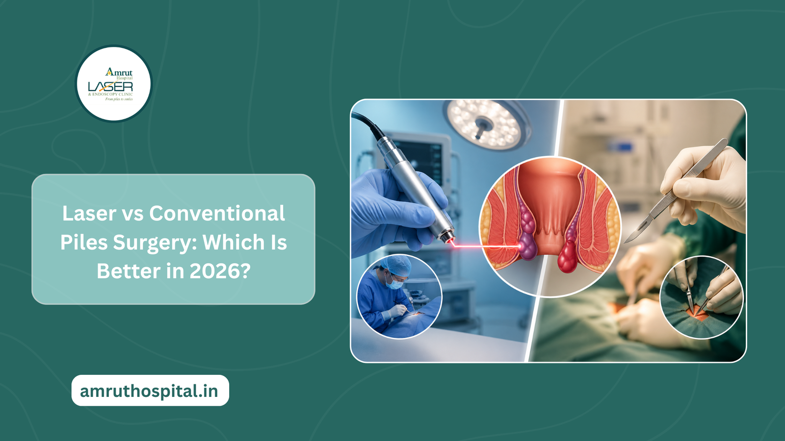 laser vs conventional piles surgery