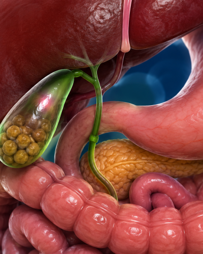 Gallstone treatment in Dombivli